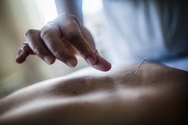 Les bienfaits de l'acupuncture pendant la grossesse pour soulager divers maux